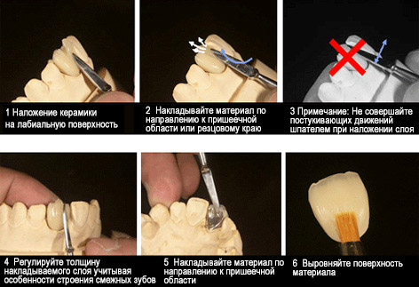 pic Procedure of Enamel build up